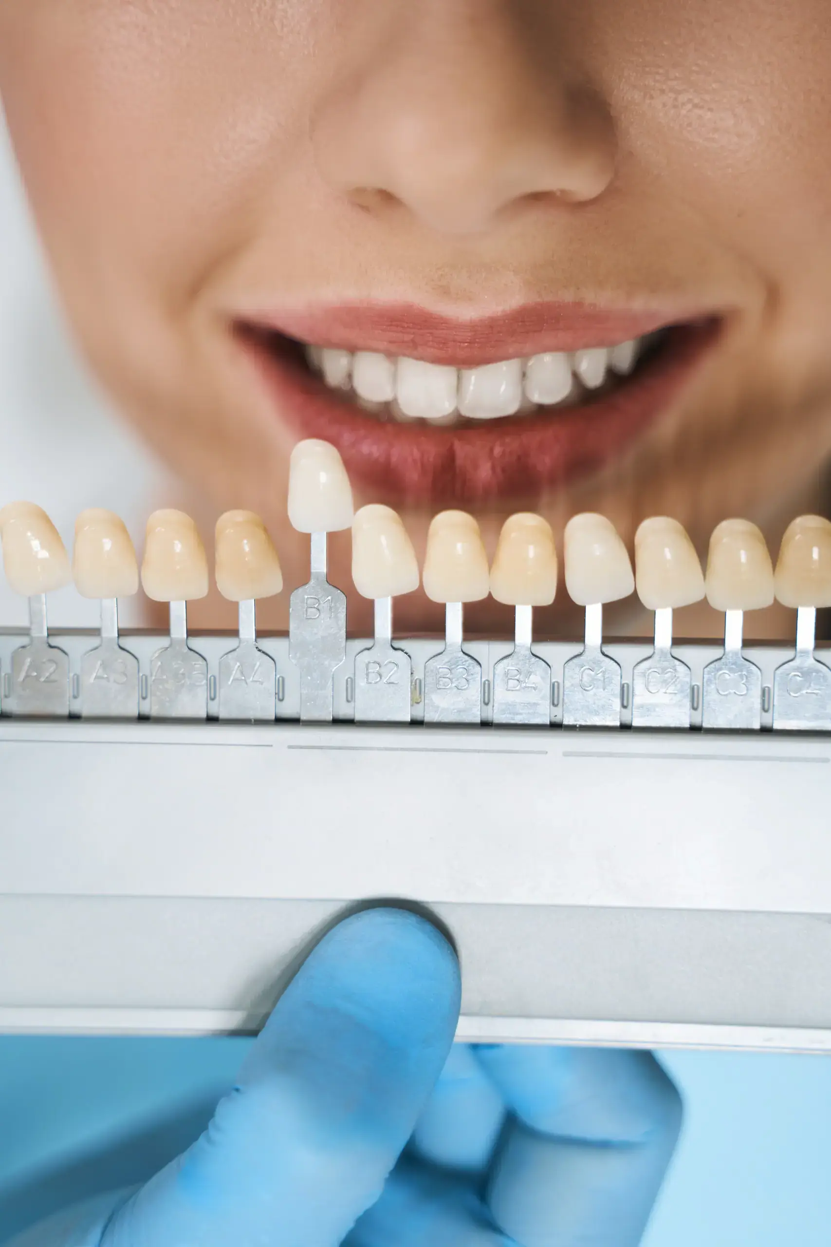 Tooth whitening treatment
